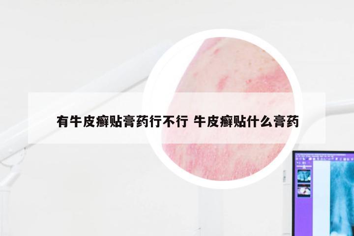 有牛皮癣贴膏药行不行 牛皮癣贴什么膏药