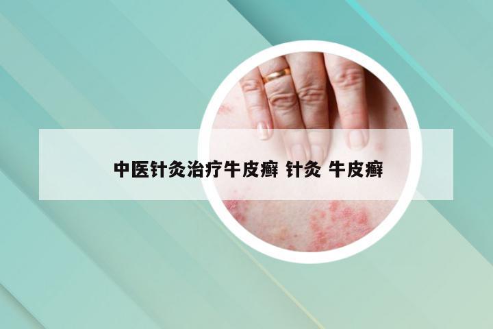 中医针灸治疗牛皮癣 针灸 牛皮癣