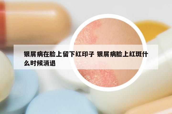 银屑病在脸上留下红印子 银屑病脸上红斑什么时候消退