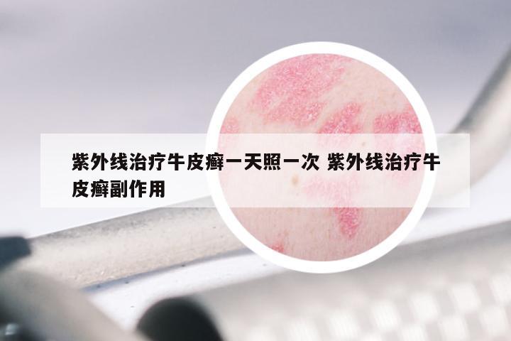 紫外线治疗牛皮癣一天照一次 紫外线治疗牛皮癣副作用
