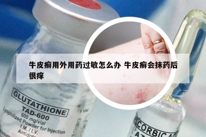 牛皮癣用外用药过敏怎么办 牛皮癣会抹药后很痒
