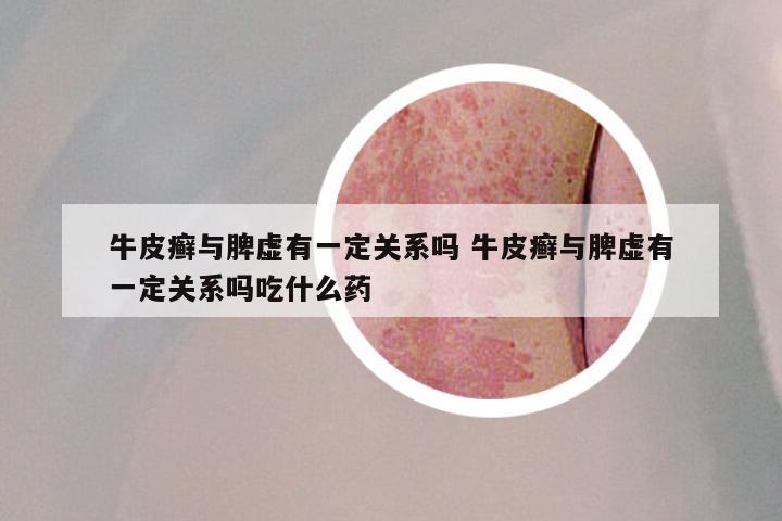 牛皮癣与脾虚有一定关系吗 牛皮癣与脾虚有一定关系吗吃什么药
