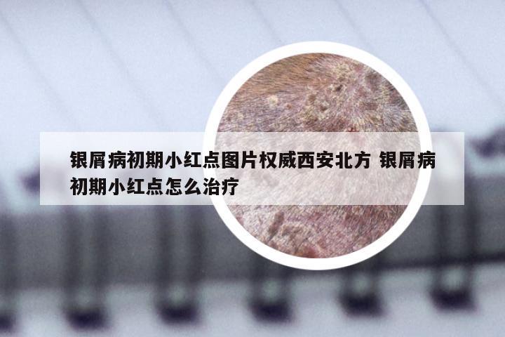 银屑病初期小红点图片权威西安北方 银屑病初期小红点怎么治疗