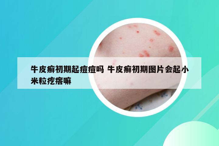 牛皮癣初期起痘痘吗 牛皮癣初期图片会起小米粒疙瘩嘛