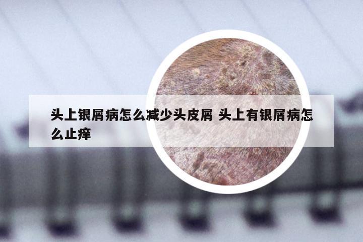 头上银屑病怎么减少头皮屑 头上有银屑病怎么止痒