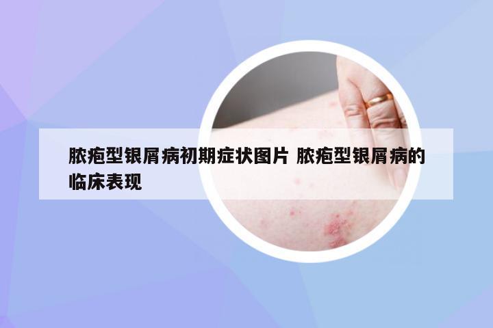 脓疱型银屑病初期症状图片 脓疱型银屑病的临床表现