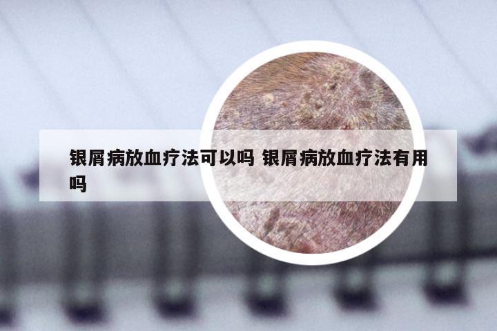 银屑病放血疗法可以吗 银屑病放血疗法有用吗