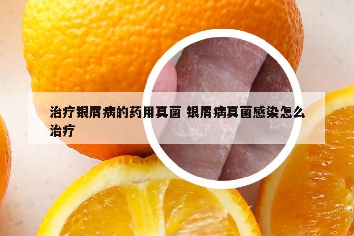 治疗银屑病的药用真菌 银屑病真菌感染怎么治疗