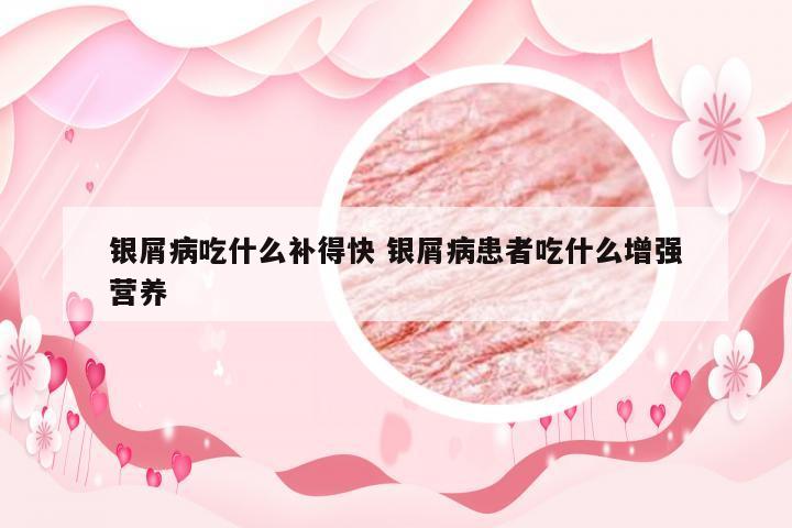 银屑病吃什么补得快 银屑病患者吃什么增强营养