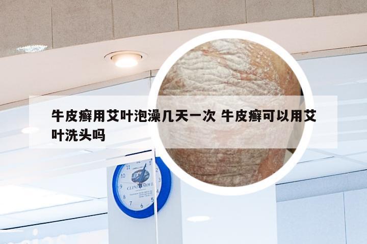 牛皮癣用艾叶泡澡几天一次 牛皮癣可以用艾叶洗头吗
