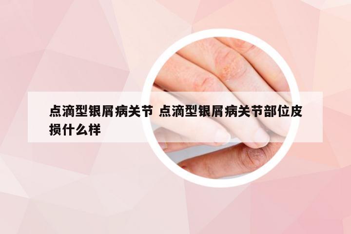 点滴型银屑病关节 点滴型银屑病关节部位皮损什么样
