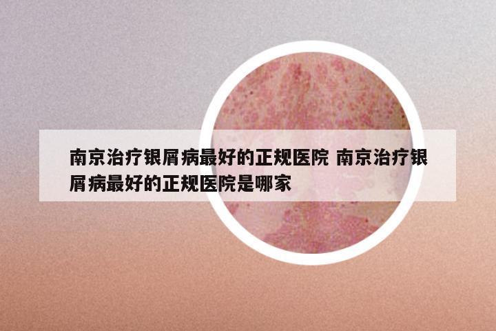 南京治疗银屑病最好的正规医院 南京治疗银屑病最好的正规医院是哪家