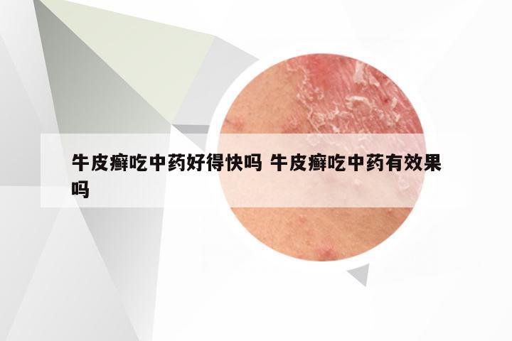 牛皮癣吃中药好得快吗 牛皮癣吃中药有效果吗