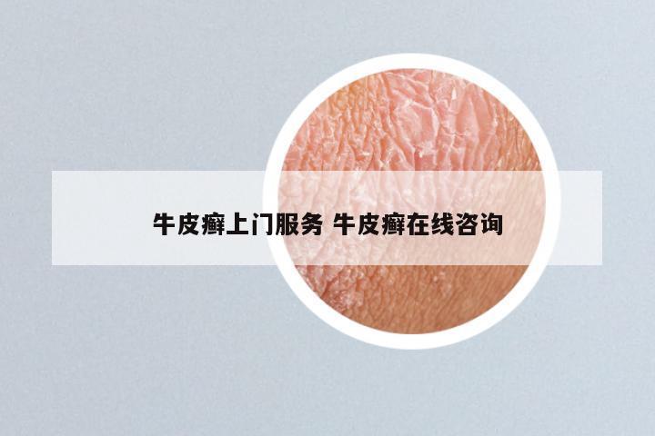 牛皮癣上门服务 牛皮癣在线咨询