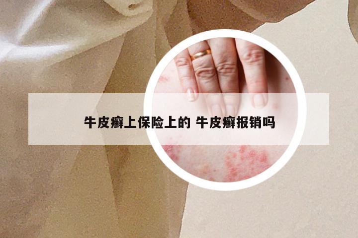 牛皮癣上保险上的 牛皮癣报销吗