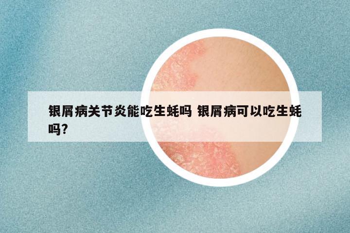 银屑病关节炎能吃生蚝吗 银屑病可以吃生蚝吗?