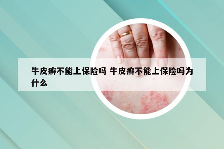 牛皮癣不能上保险吗 牛皮癣不能上保险吗为什么