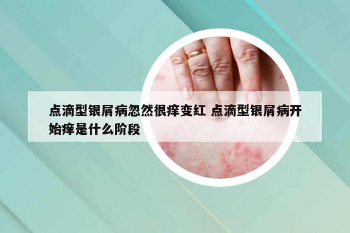 点滴型银屑病忽然很痒变红 点滴型银屑病开始痒是什么阶段