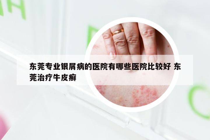东莞专业银屑病的医院有哪些医院比较好 东莞治疗牛皮癣