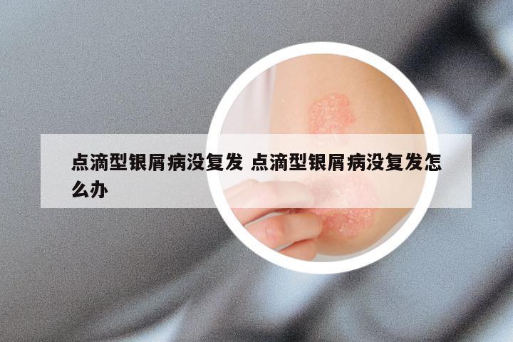 点滴型银屑病没复发 点滴型银屑病没复发怎么办