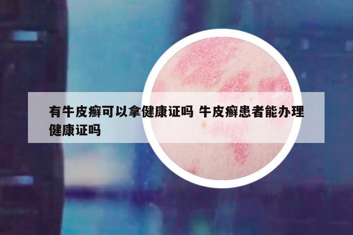 有牛皮癣可以拿健康证吗 牛皮癣患者能办理健康证吗