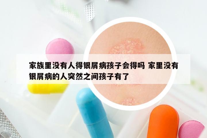 家族里没有人得银屑病孩子会得吗 家里没有银屑病的人突然之间孩子有了