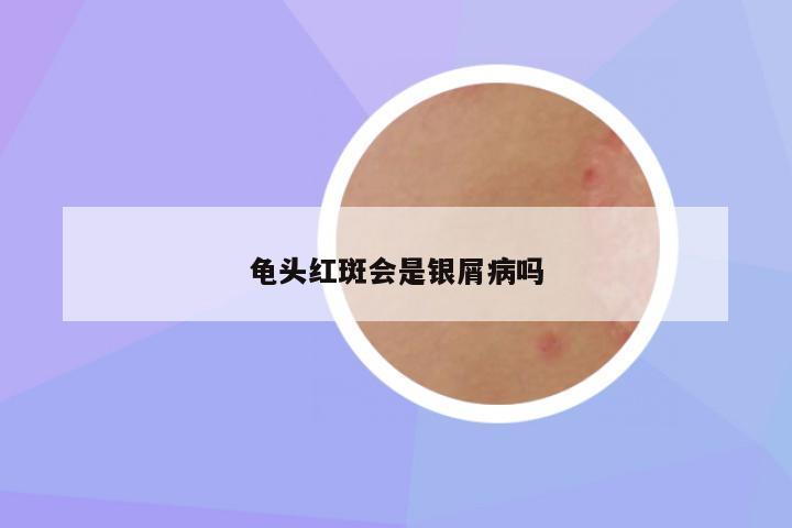 龟头红斑会是银屑病吗