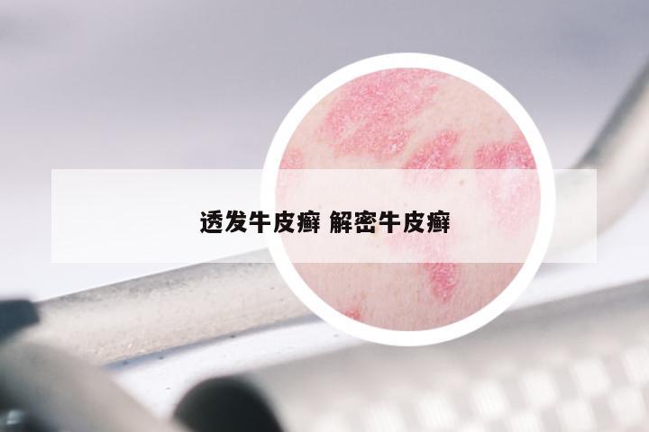 透发牛皮癣 解密牛皮癣