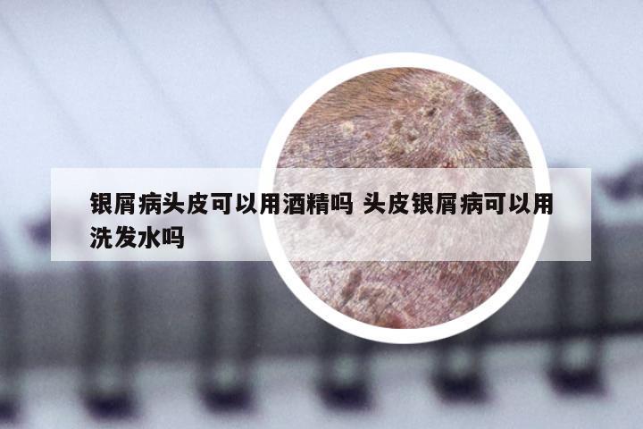 银屑病头皮可以用酒精吗 头皮银屑病可以用洗发水吗