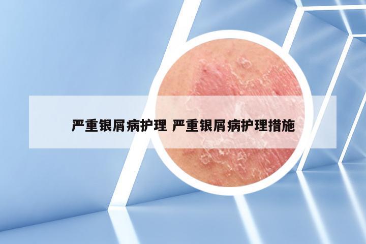 严重银屑病护理 严重银屑病护理措施